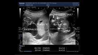 Anencephaly and Encephalocele with a pregnancy of about 16 weeks [upl. by Aik]