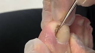 Ingrown Toenail  Impacted Toenail Removal  Toenail Fungus Treatment [upl. by Goldner]