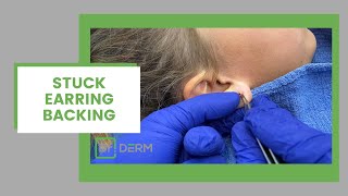 STUCK  Earring Backing Removal  Dr Derm [upl. by Enninaej]