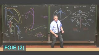 Lithiase Biliaire  3 Cholécystite aiguë compliquée [upl. by Marder348]