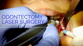 OdontectomySurgery using SOL Diode laser by DenMatRampR Newtech [upl. by Adamik]