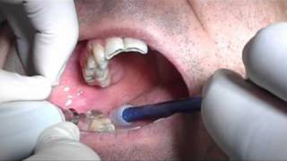 Third molars extraction without pliers and bleeding with piezosurgery in HD [upl. by Oguh591]