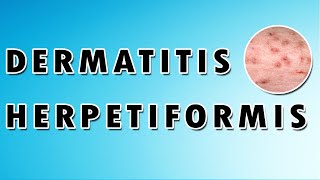 Dermatitis Herpetiformis Symptoms Treatment and Causes [upl. by Nagah822]