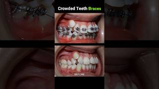 40 months for this braces Crowded teeth braces orthodontist dentist dentistry [upl. by Gonroff]