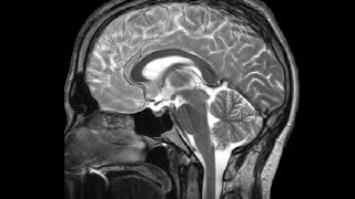 The Ventricles Neuroanatomy Video Lab  Brain Dissections [upl. by Harrow785]