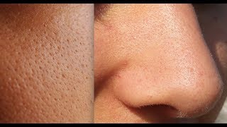 How I Shrank My Pores How To Shrink Pores And Best Products To Remove Blackheads On Nose [upl. by Nawrocki]