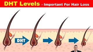 👱 High DHT Affects How Much Hair You Have On Your Head  Hair Loss Part 3 [upl. by Dimond]