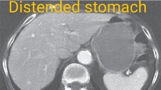 Distended stomach  CECT ABDOMEN AND PELVIS  plain abdomen [upl. by Elleirb]