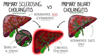 Primary Sclerosing Cholangitis v Primary Biliary Cholangitis Primary Biliary Cirrhosis [upl. by Nairdna932]