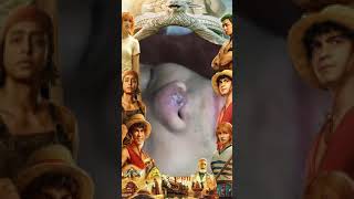 Blackheads Removal  Acne Treatment and Very Satisfying Satisfying Pimple pop blackheads [upl. by Ahseinek]