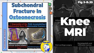 Fig 5B35 Patterns of Subchondral Bone Plate Fracture in Osteonecrosis [upl. by Ysak]