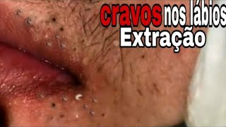 Removendo CRAVOS dos labios  SATISFATÓRIO  cravos na boca 😮  Agora a NASA vem  Gambiarra Master [upl. by Htenywg]