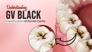 Understanding GV Black Classification of Dental Caries  Dentalkart [upl. by Enilada29]