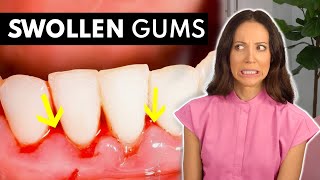 What SWOLLEN GUMS Are Telling You amp What To Do About It [upl. by Sandon]