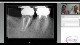 La chirurgie endodontique  le choix de la conservation [upl. by Emilee753]